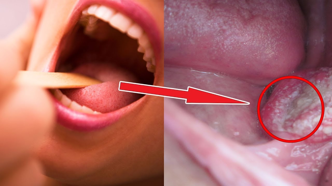 Các dấu hiệu phát hiện ung thư vòm họng sớm nhất | Antican.vn