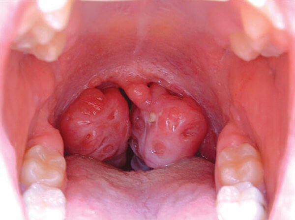Hình ảnh ung thư vòm họng giai đoạn 4
