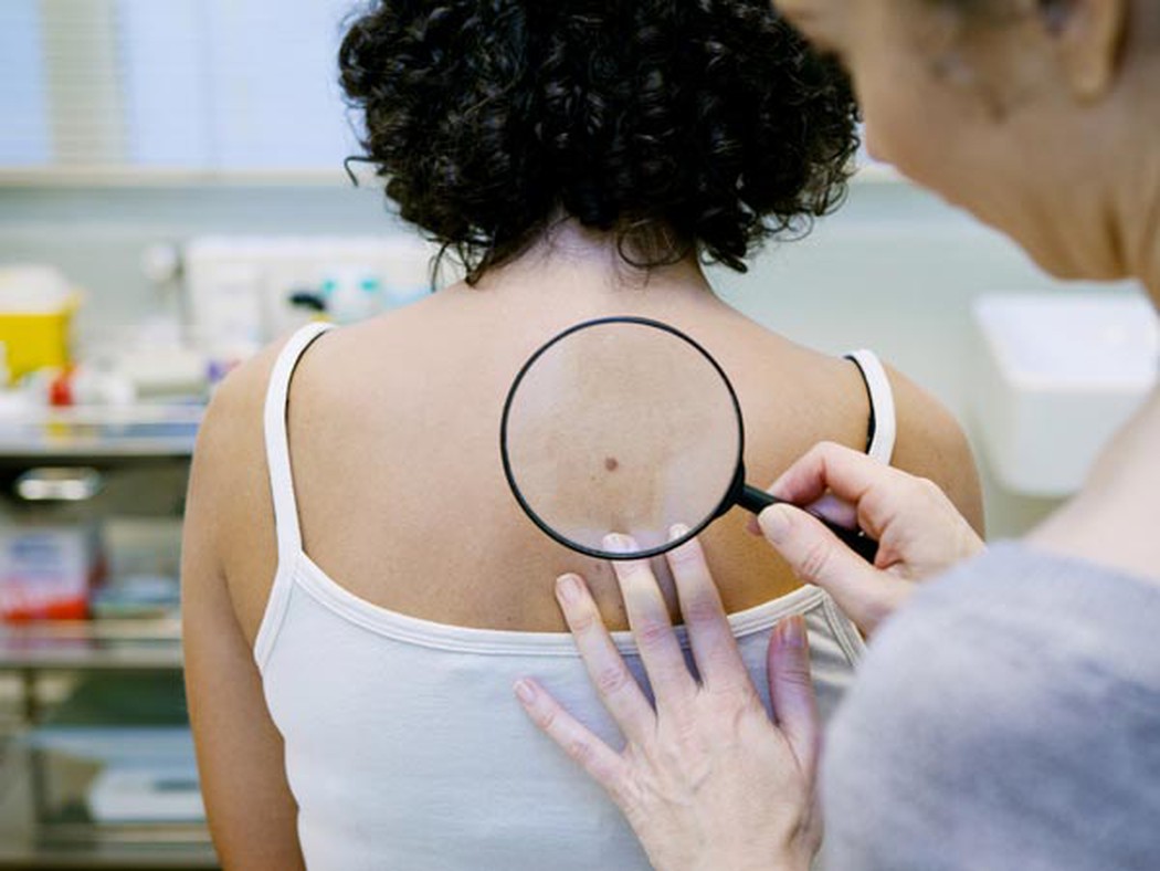 Các bất thường trên da có thể là dấu hiệu ung thư sớm
