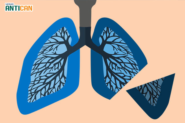 Điều trị ung thư phổi bằng phương pháp phẫu thuật