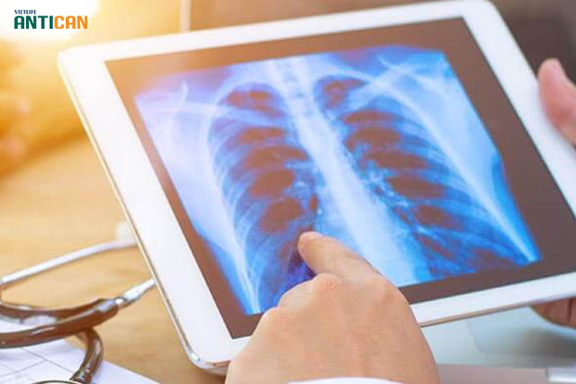 xét nghiệm ung thư phổi bằng phương pháp chụp X Quang